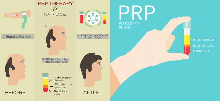 Using Your Own Cells to Repair Your Body – PRP & Prolotherapy